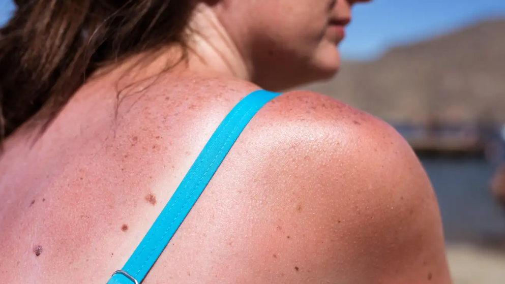 Ren Ecosystem. What to Do (and Not Do) When Your Sunburn Starts Peeling