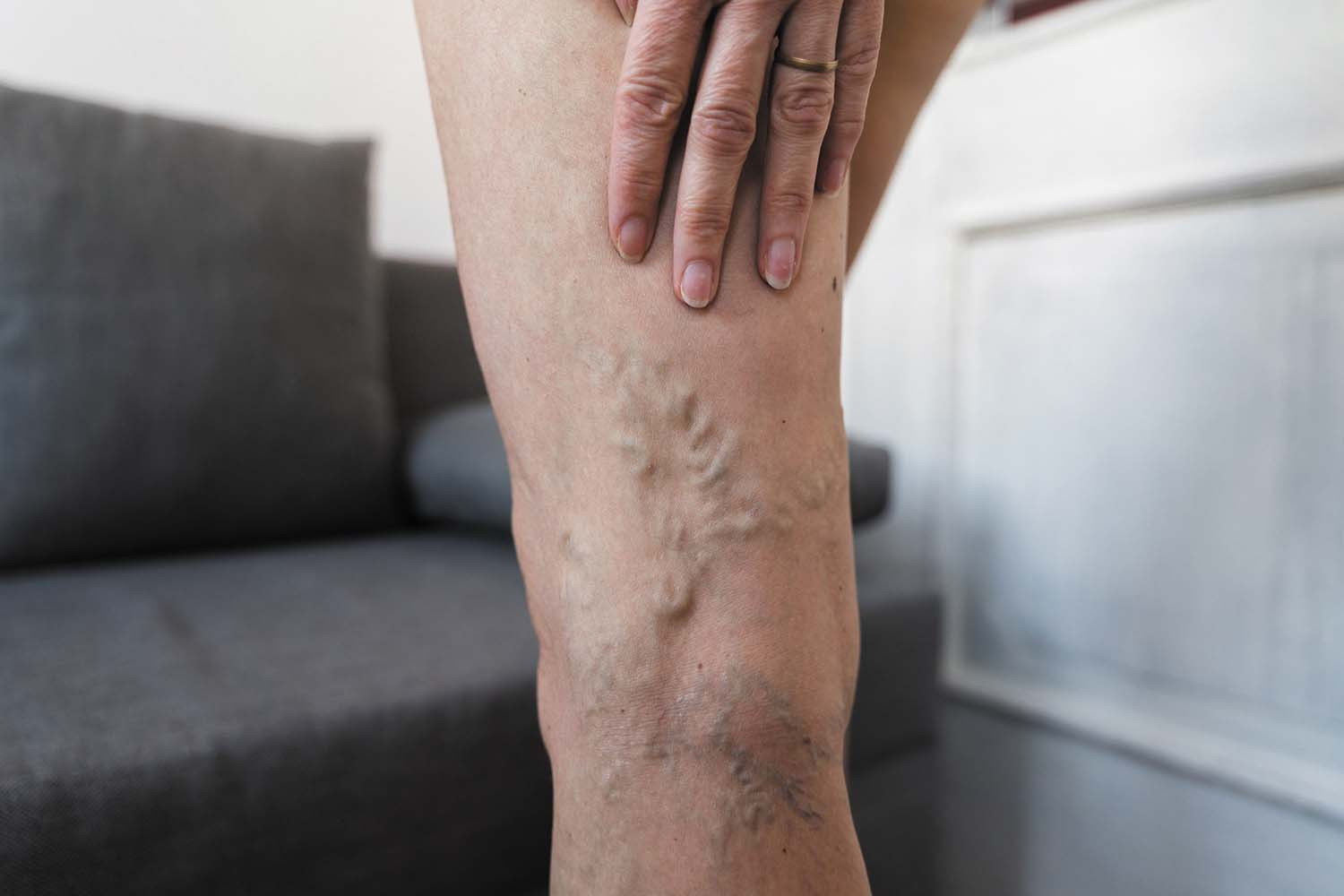 Picture of Can blue light therapy erase varicose veins?
