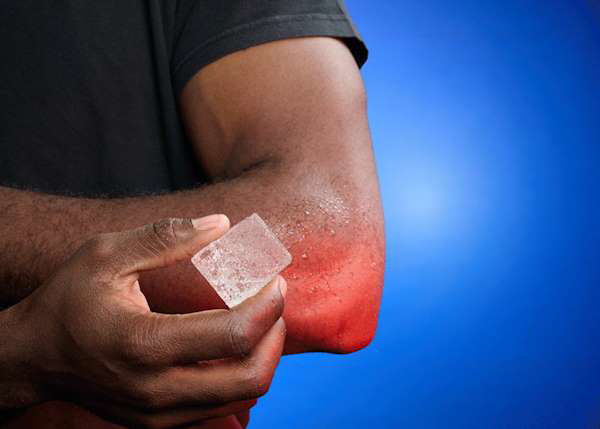 Picture of No, please don’t put ice on your burns